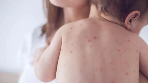 Kyrgyzstan registers over 8,000 measles cases